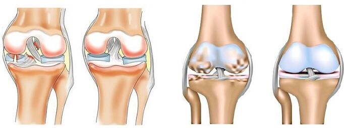 Qu'est-ce que l'arthrite et l'arthrose